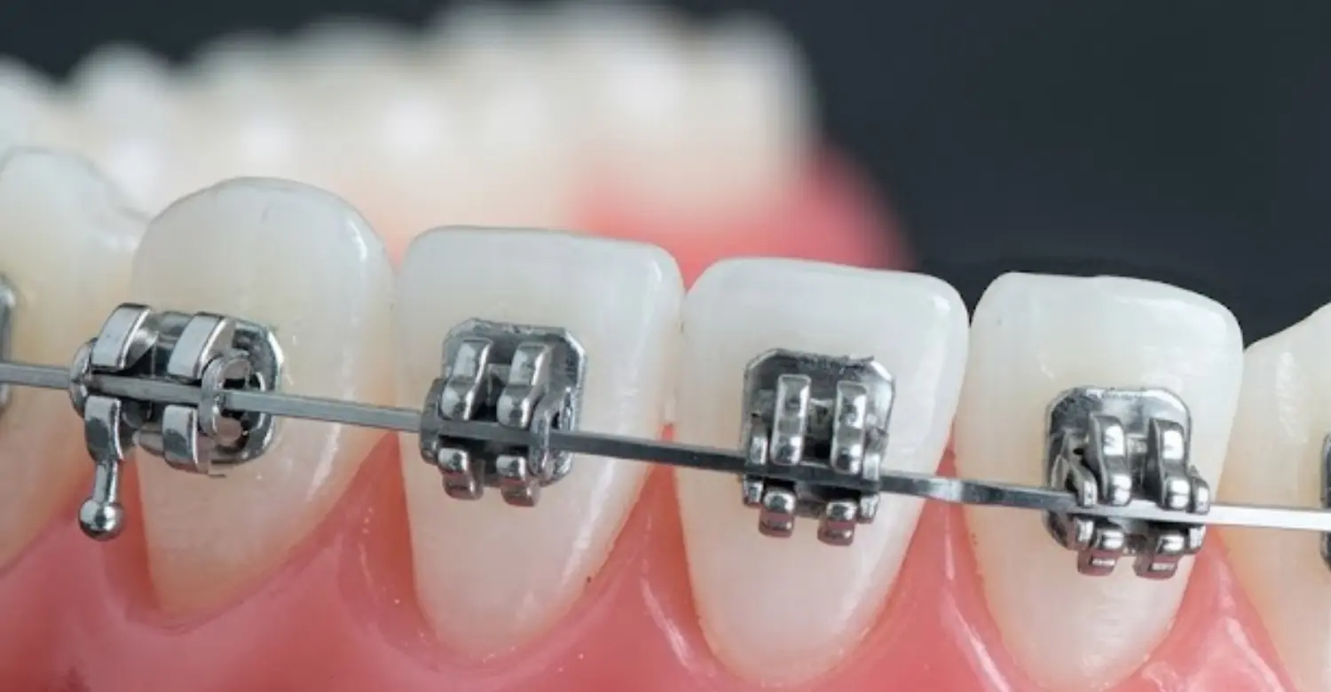 Do orthodontics remove wisdom teeth 2